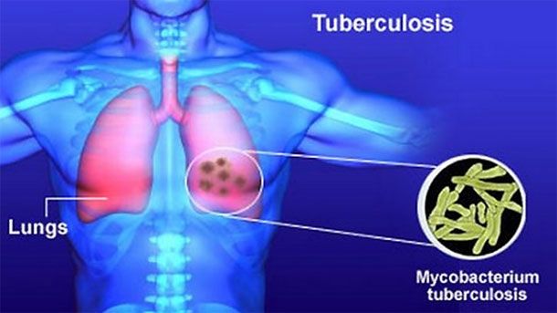 Днес е Световният ден за борба с туберкулозата