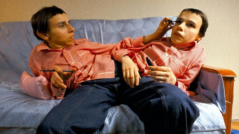 Страданията и мъките на най-известните сиамски близнаци на СССР